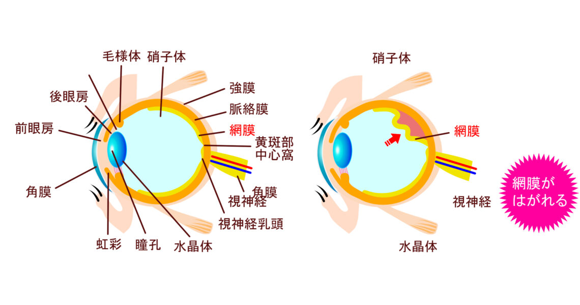 網膜剥離の図解