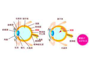 網膜剥離の図解